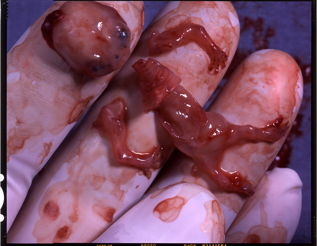 Early Miscarriage Clots