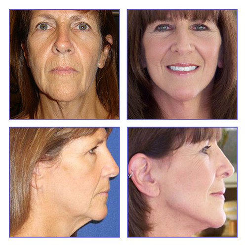 Lifestyle Lift Before and After 9 Susan was suffering fr… Flickr