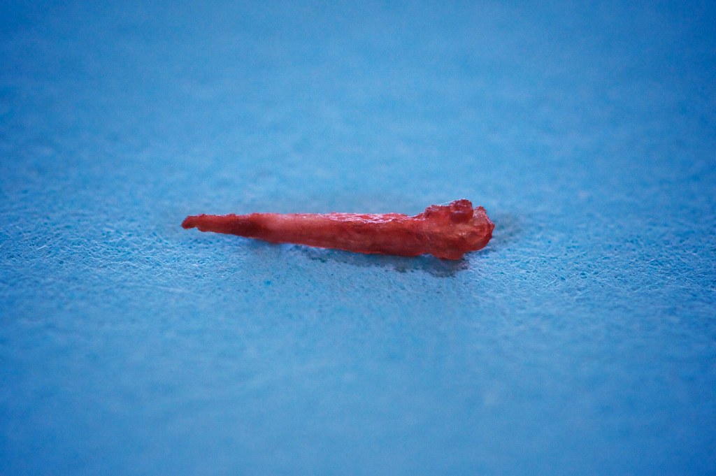 My root canal Here is a bit of my tooth's nerve ending