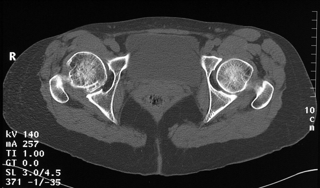 CT Scan of the Hip(s)_RemakeHealth A CT Scan of the Hip ca… Flickr