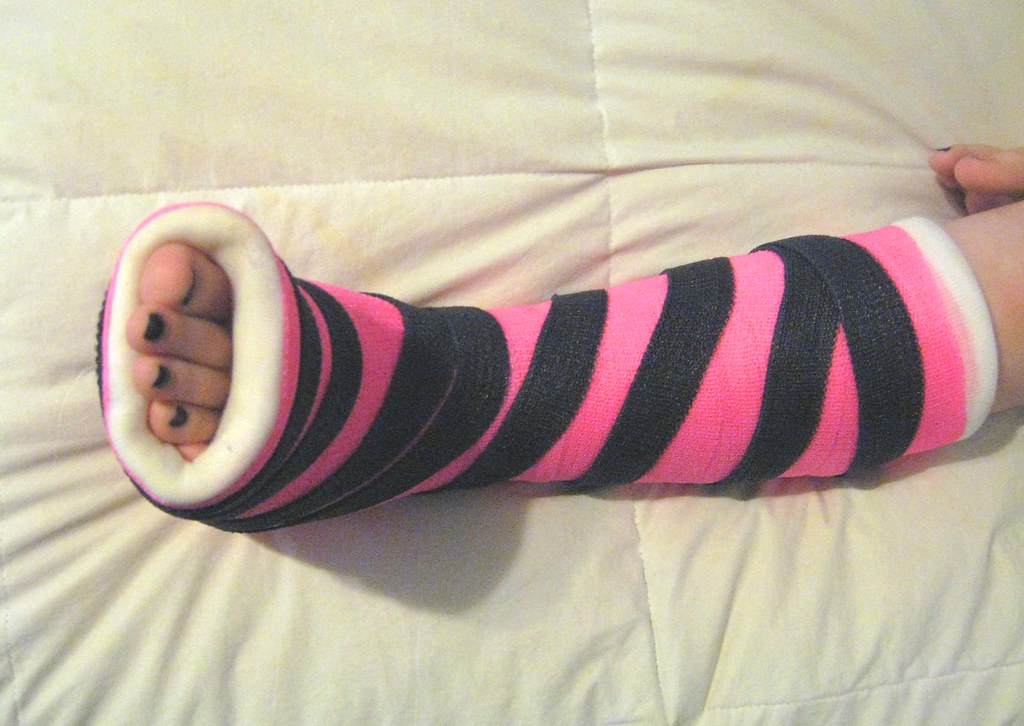a broken toe Yes, all that cast for my daughter's broken p… Flickr