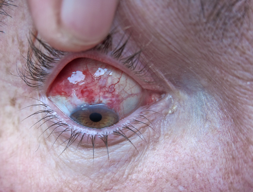 Eye Surgery Post Op In addition to the cataract lens imp… Flickr
