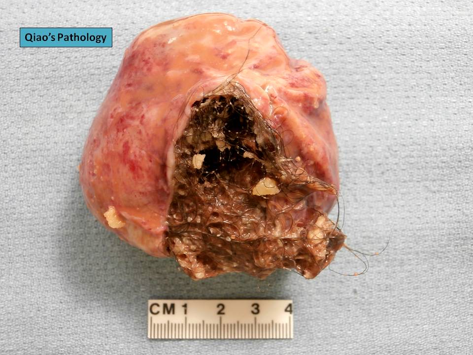 Teratoma De Ovario