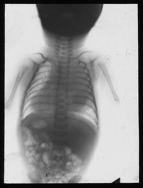 Xray of Child Xray machines were invented in 1895. They … Flickr