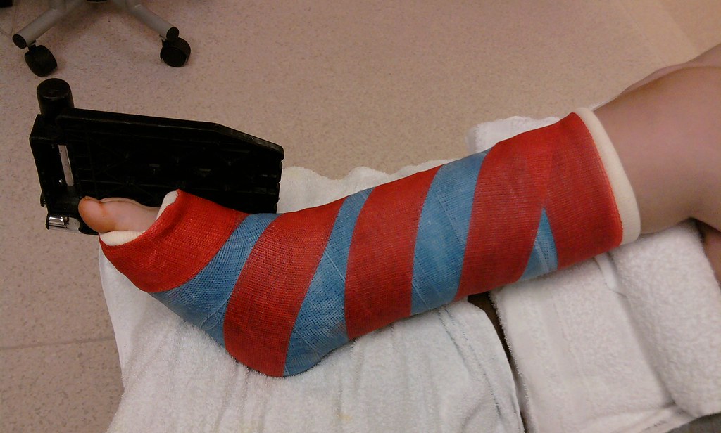 Leg cast, full cast Got a new cast on the right leg today,… Flickr