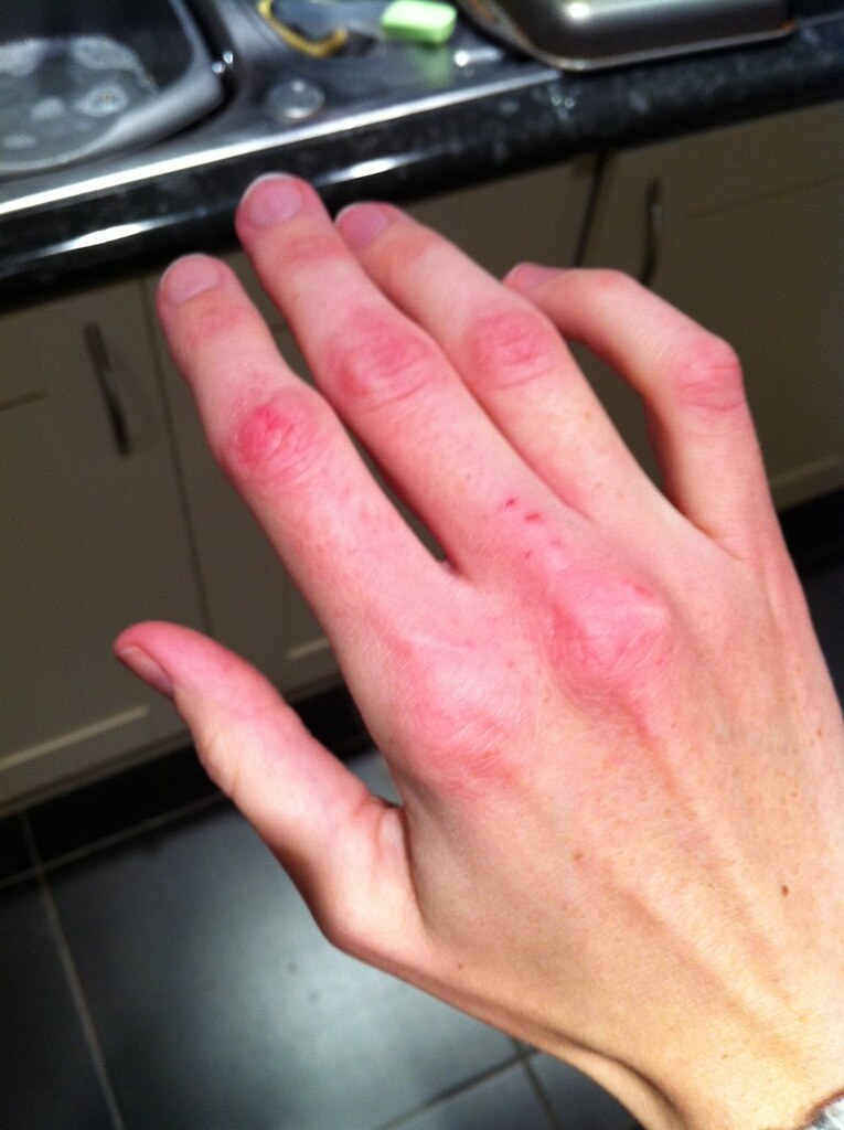 Right hand, day 2. Knuckles cracking. Very sore ( Flickr