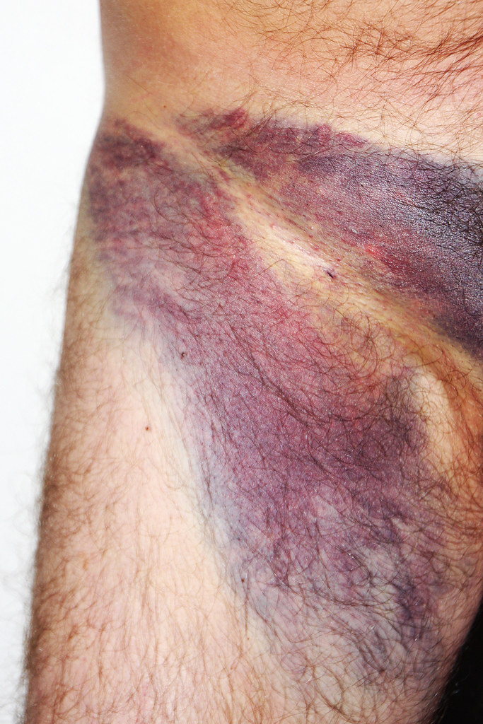 Swollen groin after coronary angiogram Swelling (known as … Flickr