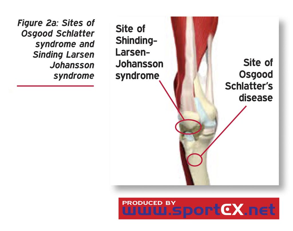 Sites of Osgood Schlatter syndrome and Sinding Larsen Joha… Flickr