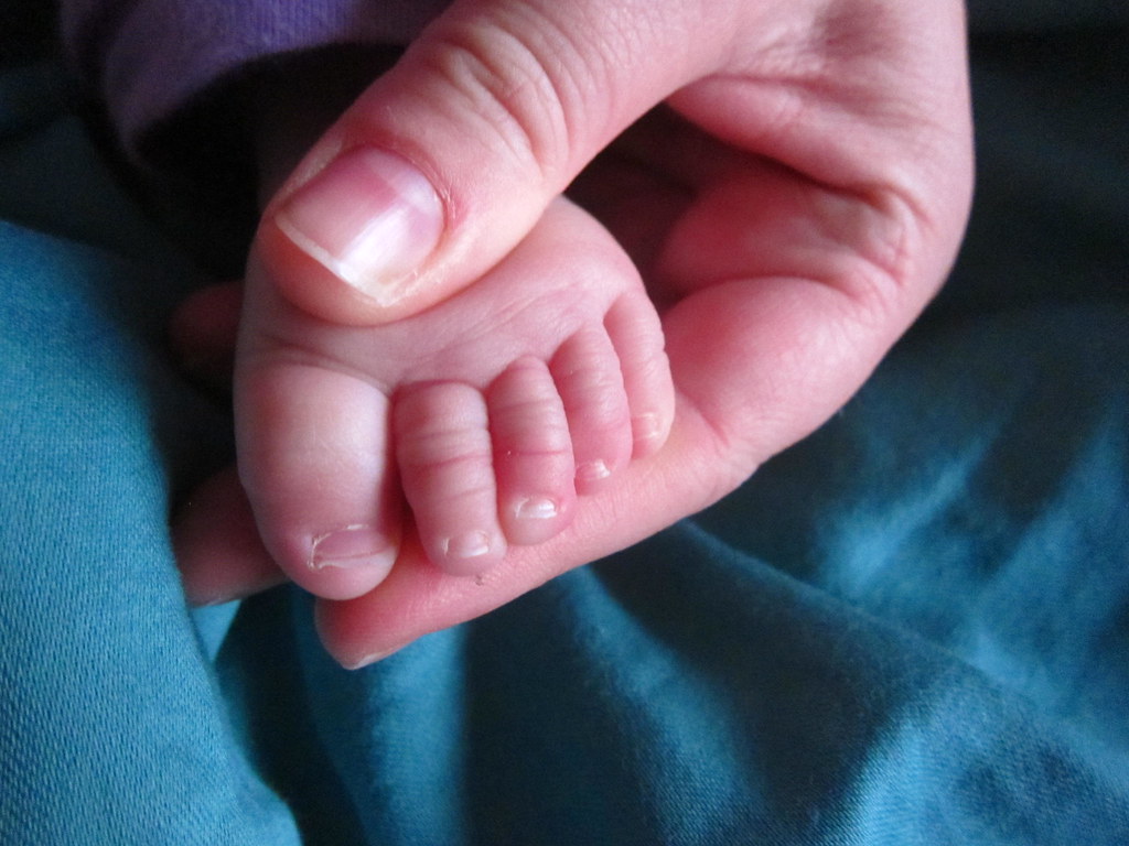 Toe Hair Tourniquet After about 18 hours of Beatrix inexpl… Flickr