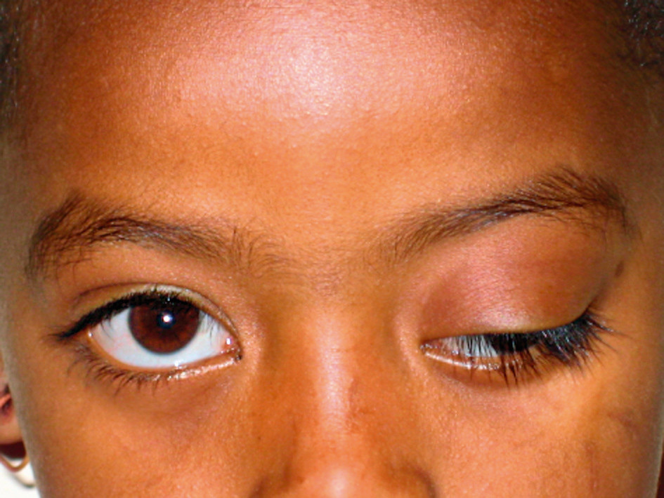 Outward deviation of the eye with ptosis, or a drooping li… Flickr