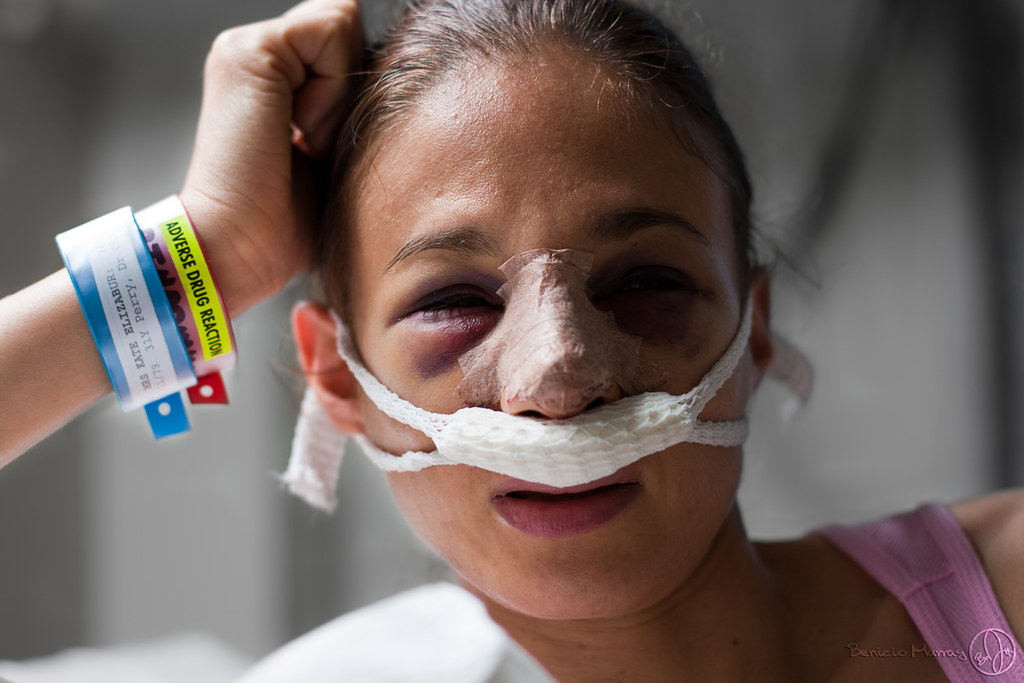 Adverse Drug Reaction from Wikipedia DEVIATED SEPTUM "The… Flickr