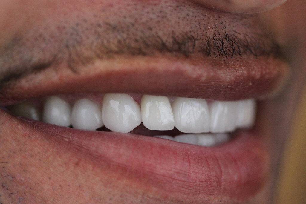 10 Crowns and veneers of the upper front teeth. The middle… Flickr