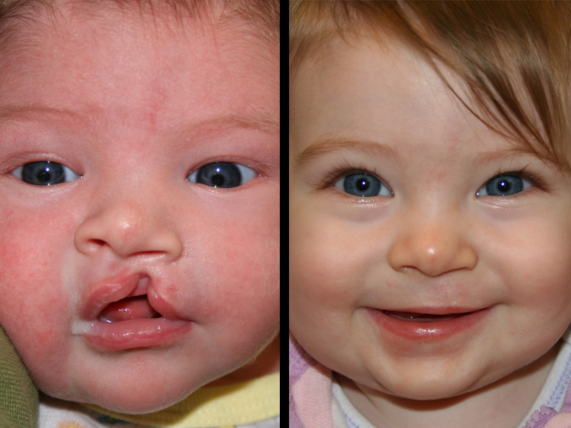 Cleft Lip Recontruction Surgery Pre op photo at age 2 mont… Flickr