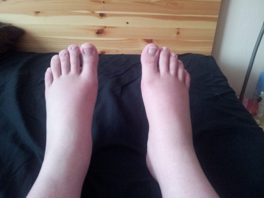 swollen feet ezwangerschapskalender.nl feel free to use th… Flickr