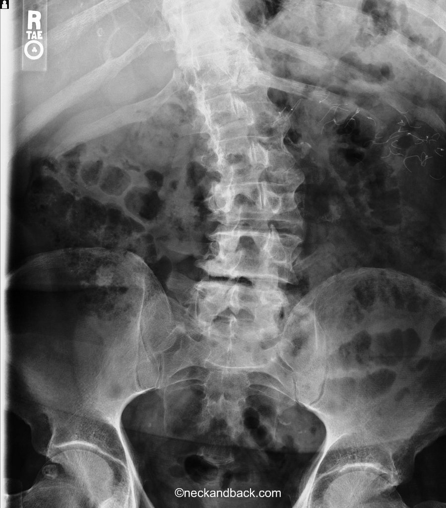 Degenerative Scoliosis Curvature of the Spine Degenera… Flickr
