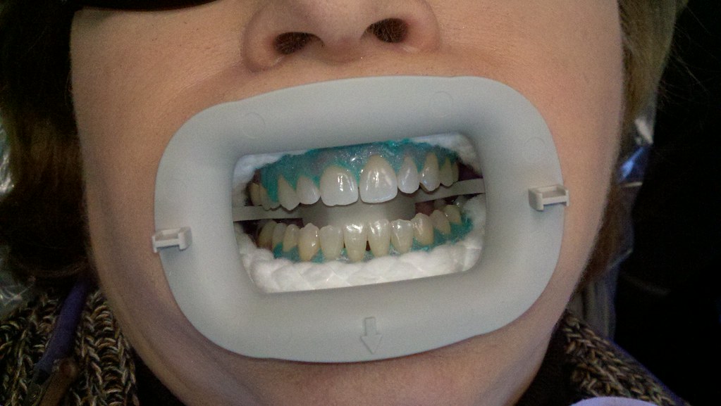 Professional Teeth Whitening. Tigard TenderCare Dental 115… Flickr