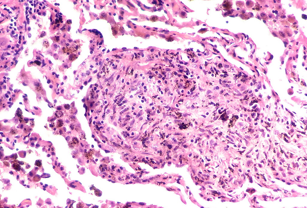 Silicosis Dust macule The earliest lesion of silicosis c… Flickr