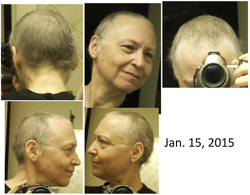 How long after chemo does it usually take you get your hair back