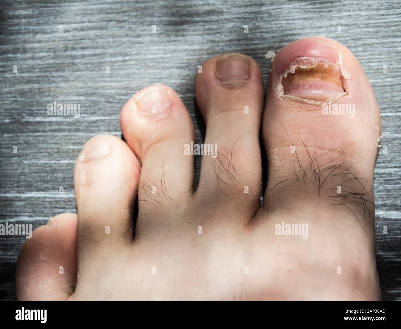 Damaged thumb nail Stock Photo Alamy