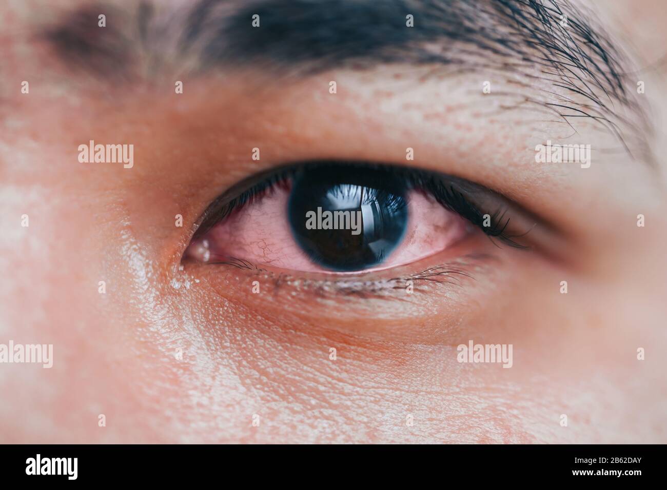 sick red eye Stock Photo Alamy