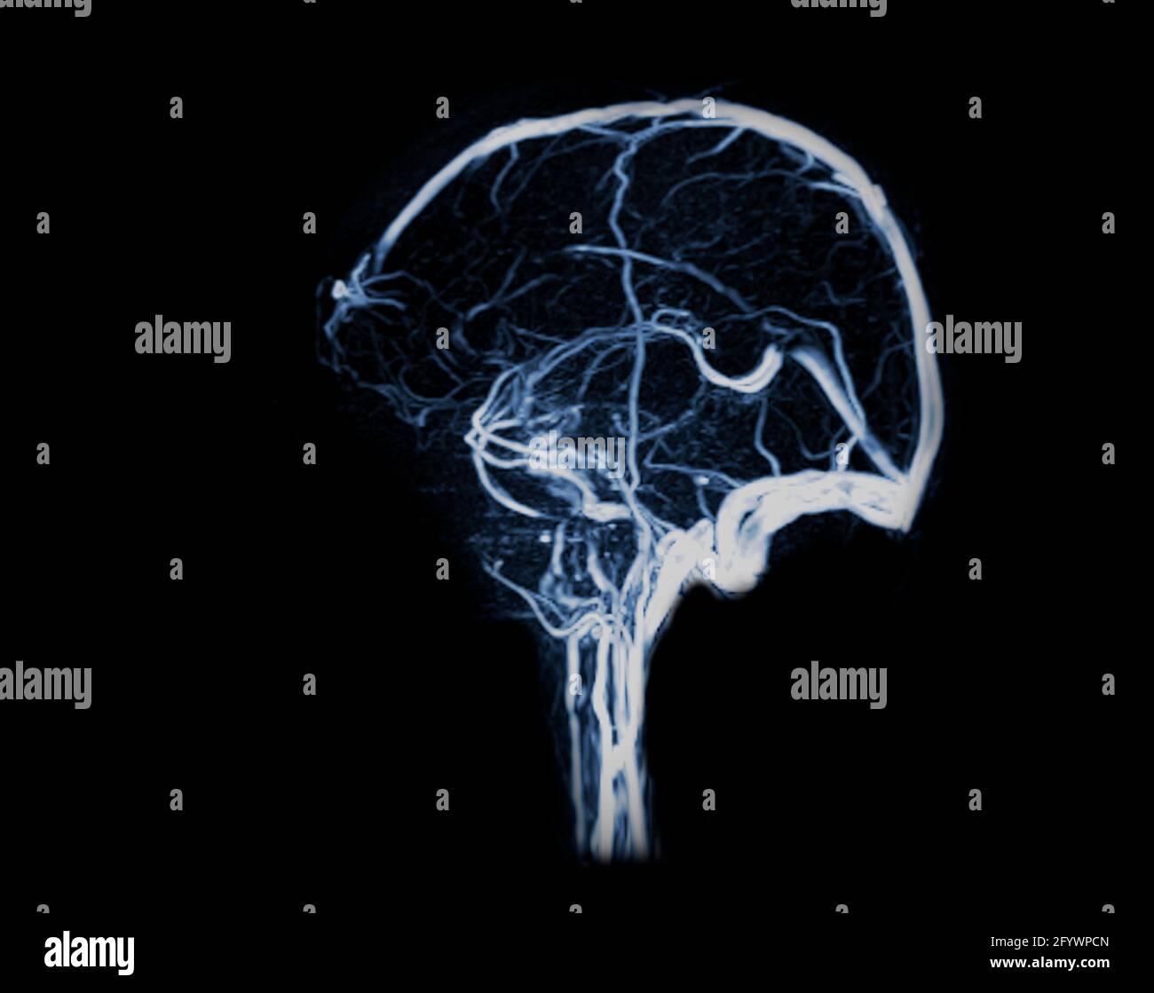 All 32+ Background Images what is an mrv of the brain Latest