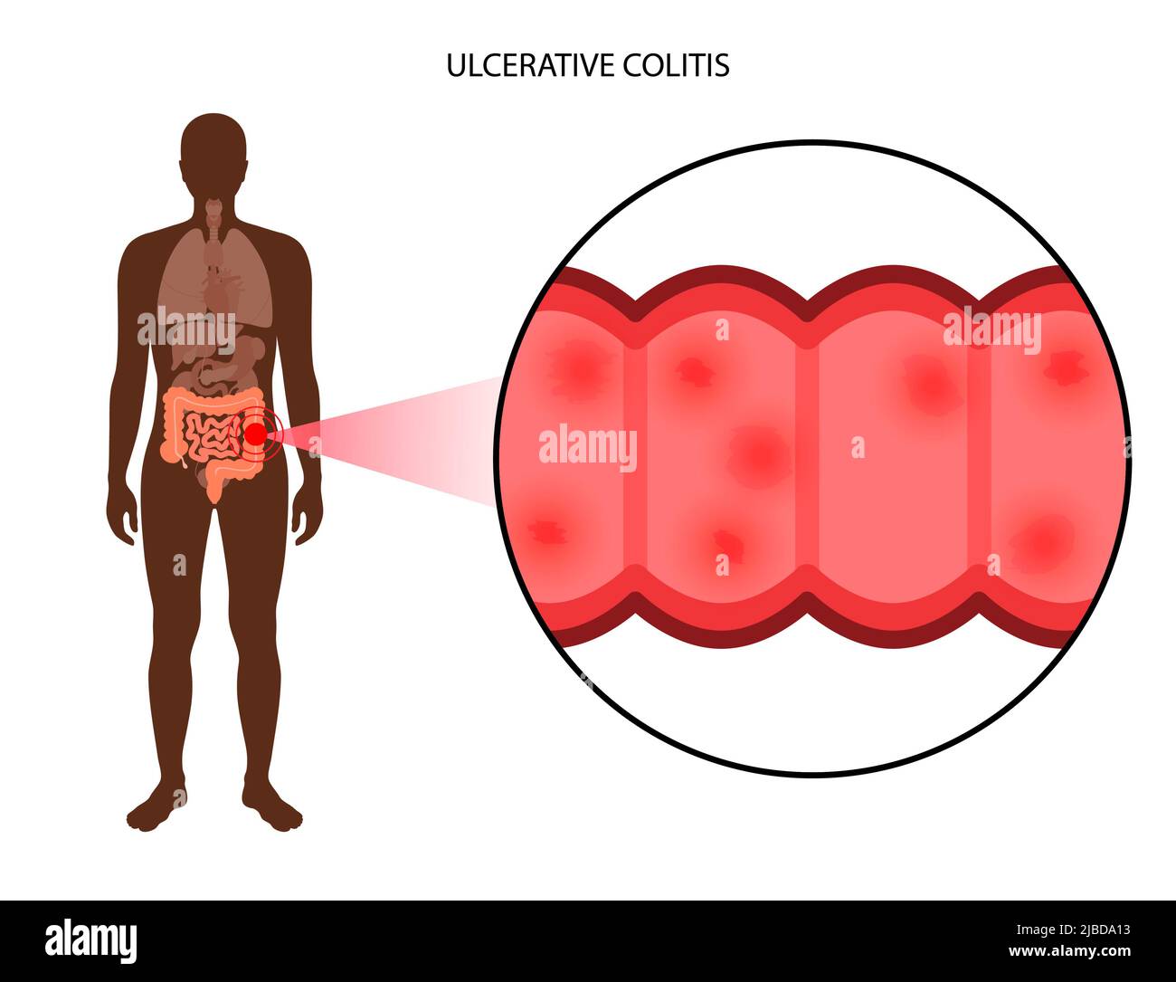 Ulcerative colitis, illustration Stock Photo Alamy