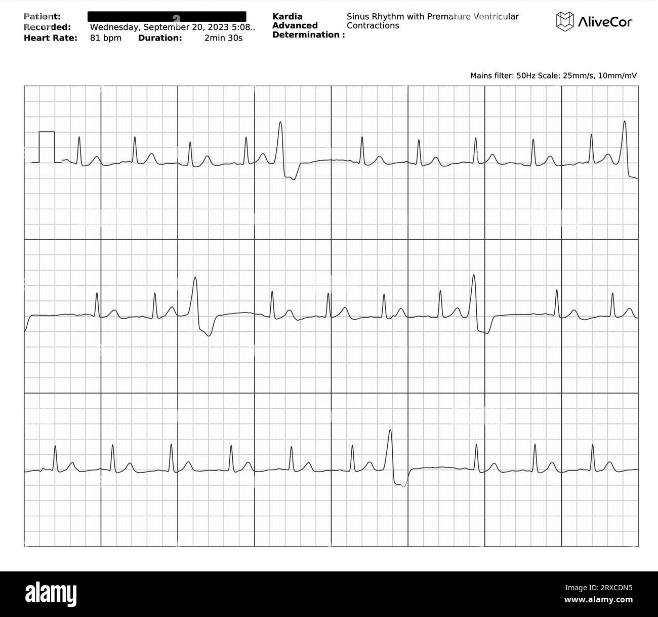 ECG / EKG graph / plot / chart / trace showing some Premature