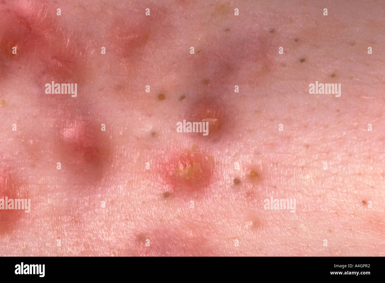 Keloid scarring hires stock photography and images Alamy