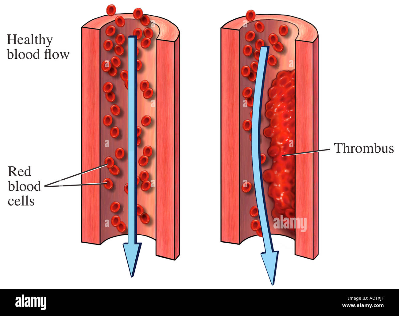 Thrombus Stock Photo Alamy