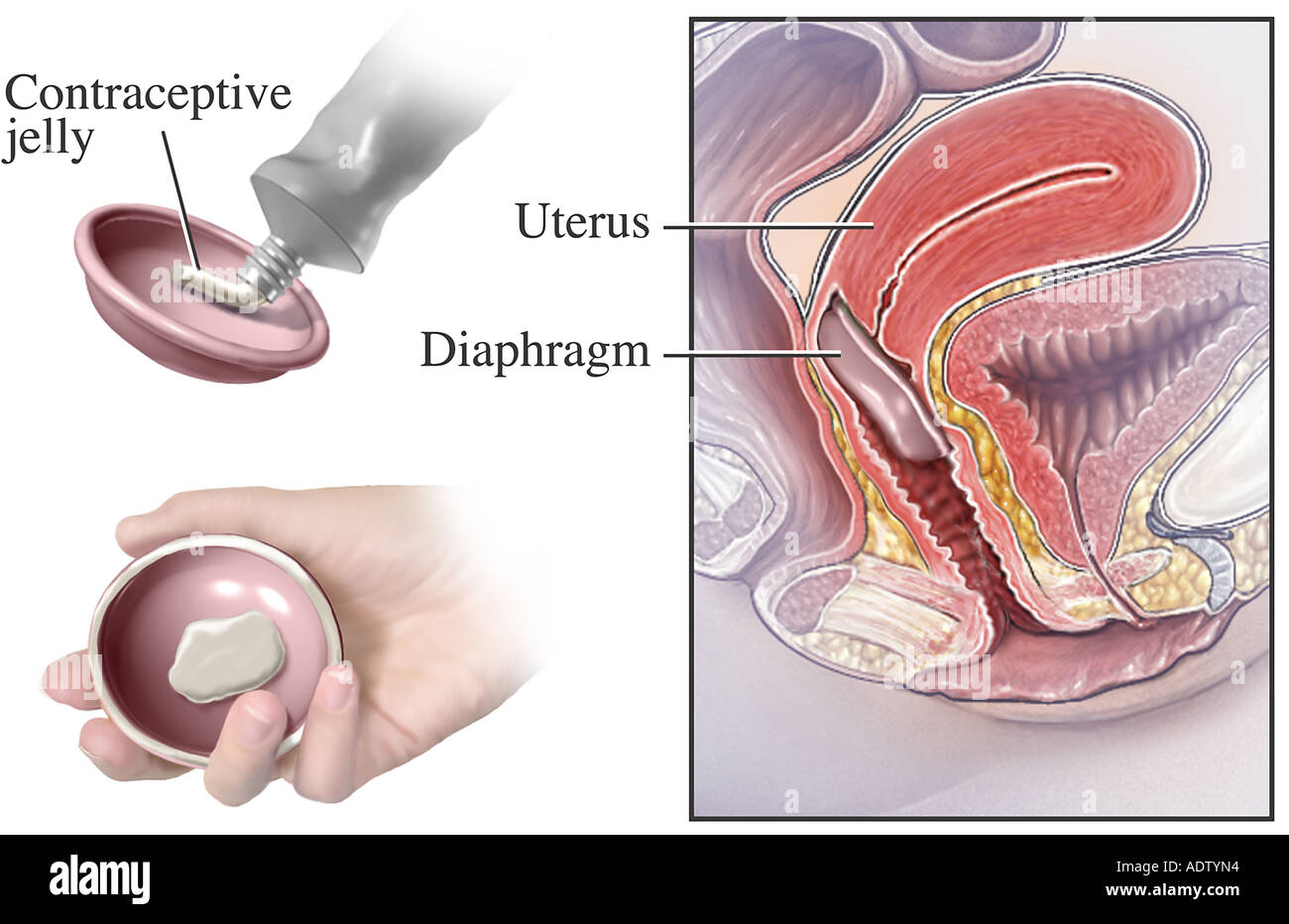 How To Use A Diaphragm Birth Control