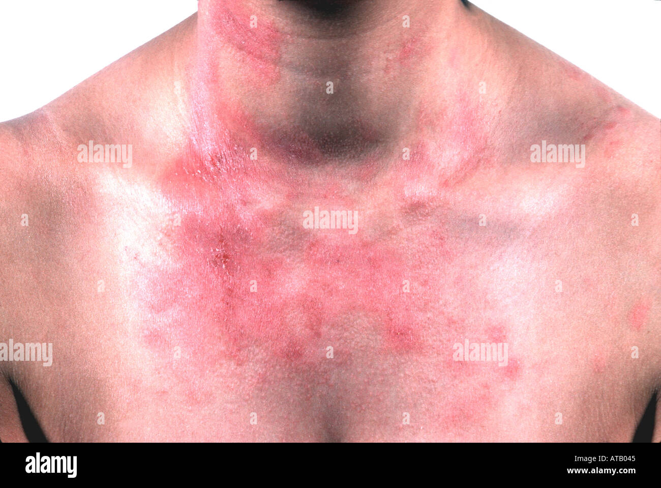 Allergic contact eczema dermatitis rash hires stock photography and