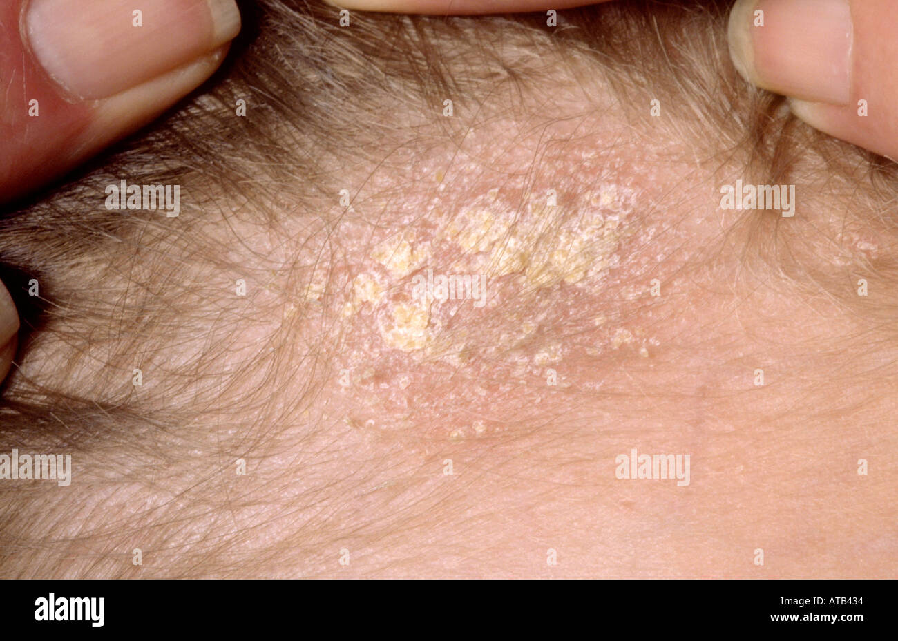 Tinea capitis Stock Photo 1684531 Alamy