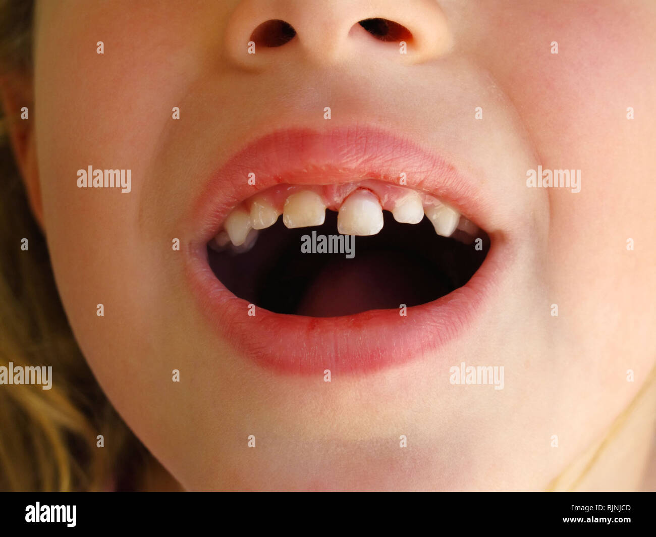 Loose tooth Stock Photo - Alamy