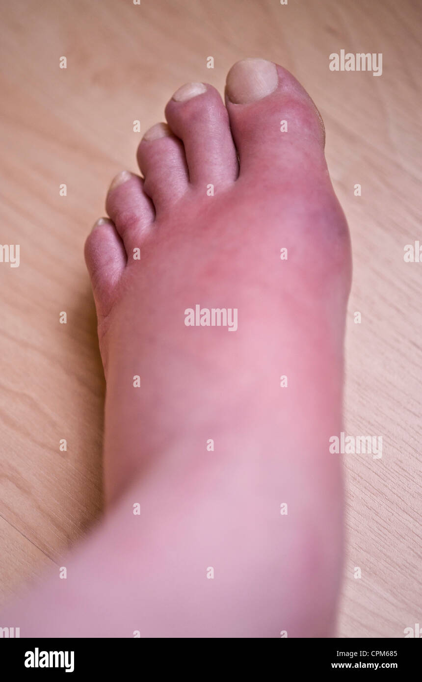 Gout Foot High Resolution Stock Photography and Images Alamy
