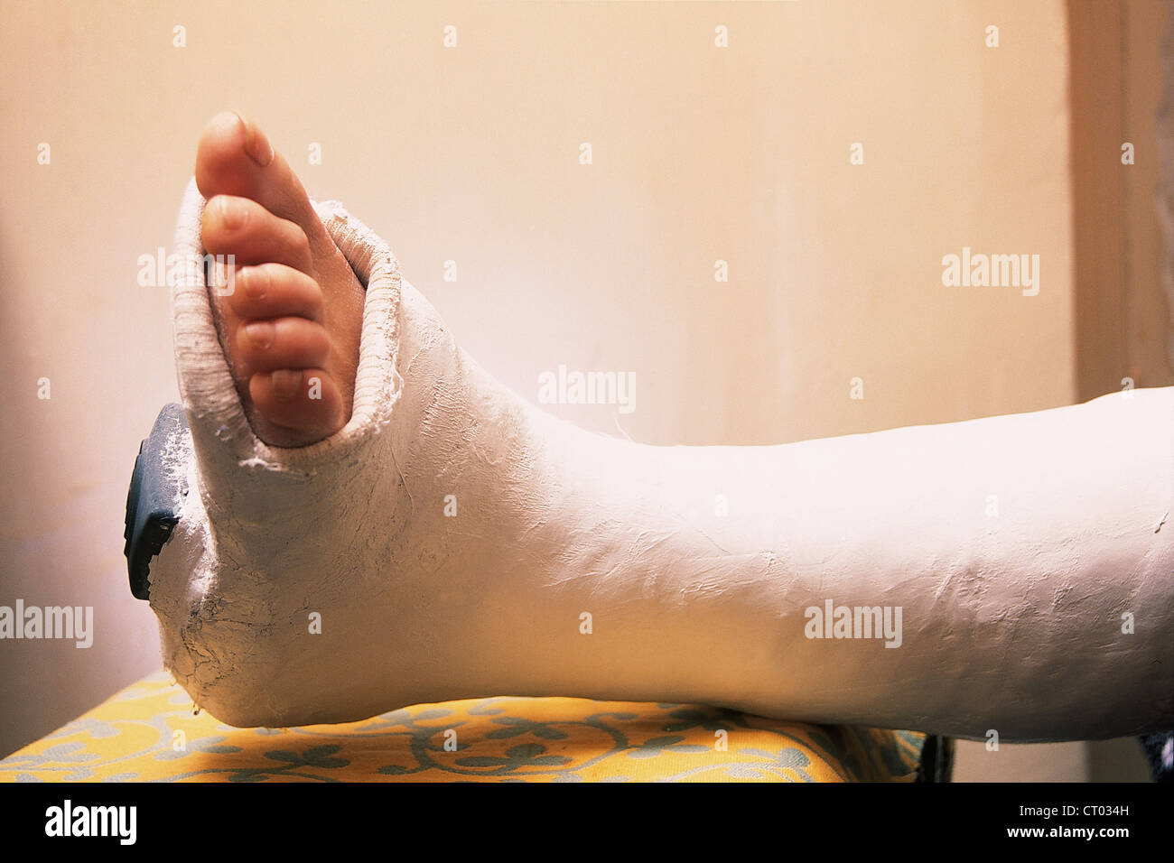 Plaster Leg Cast Legs Stock Photos & Plaster Leg Cast Legs Stock Images