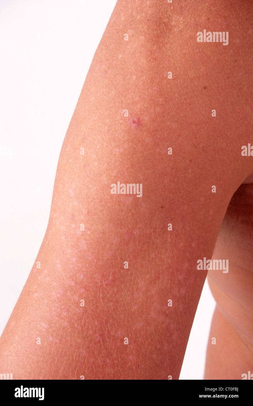 POLYMORPHOUS LIGHT ERUPTION Stock Photo Alamy