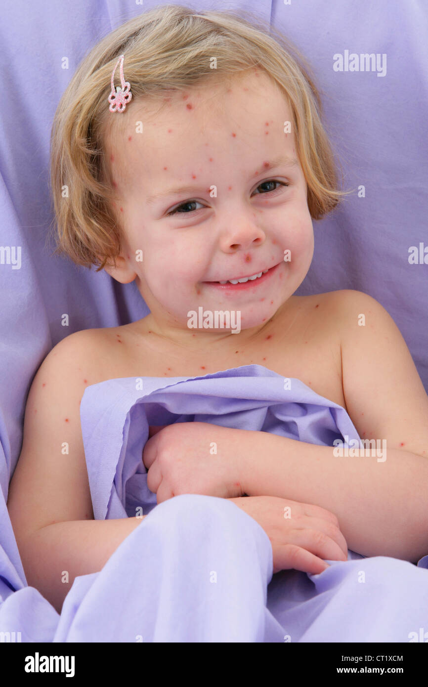 Year old girl chicken pox hires stock photography and images Alamy