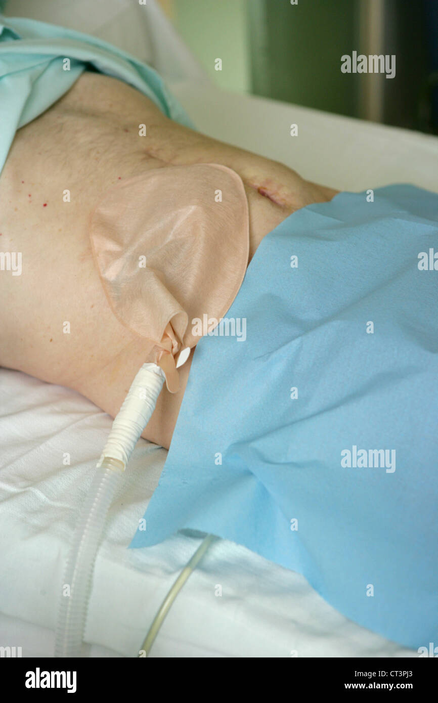 Colostomy bag hires stock photography and images Alamy