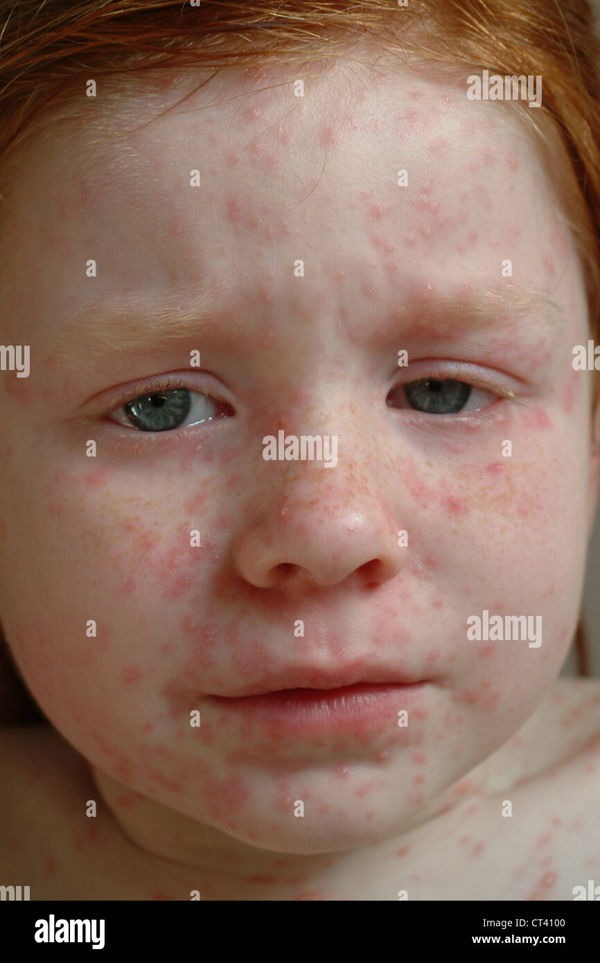 Girl chickenpox spots hires stock photography and images Alamy