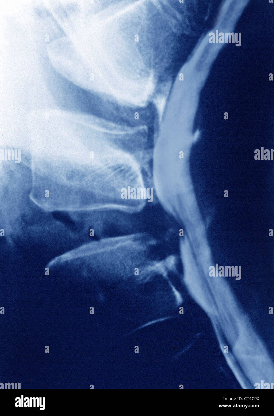 Herniated cervical discs hires stock photography and images Alamy