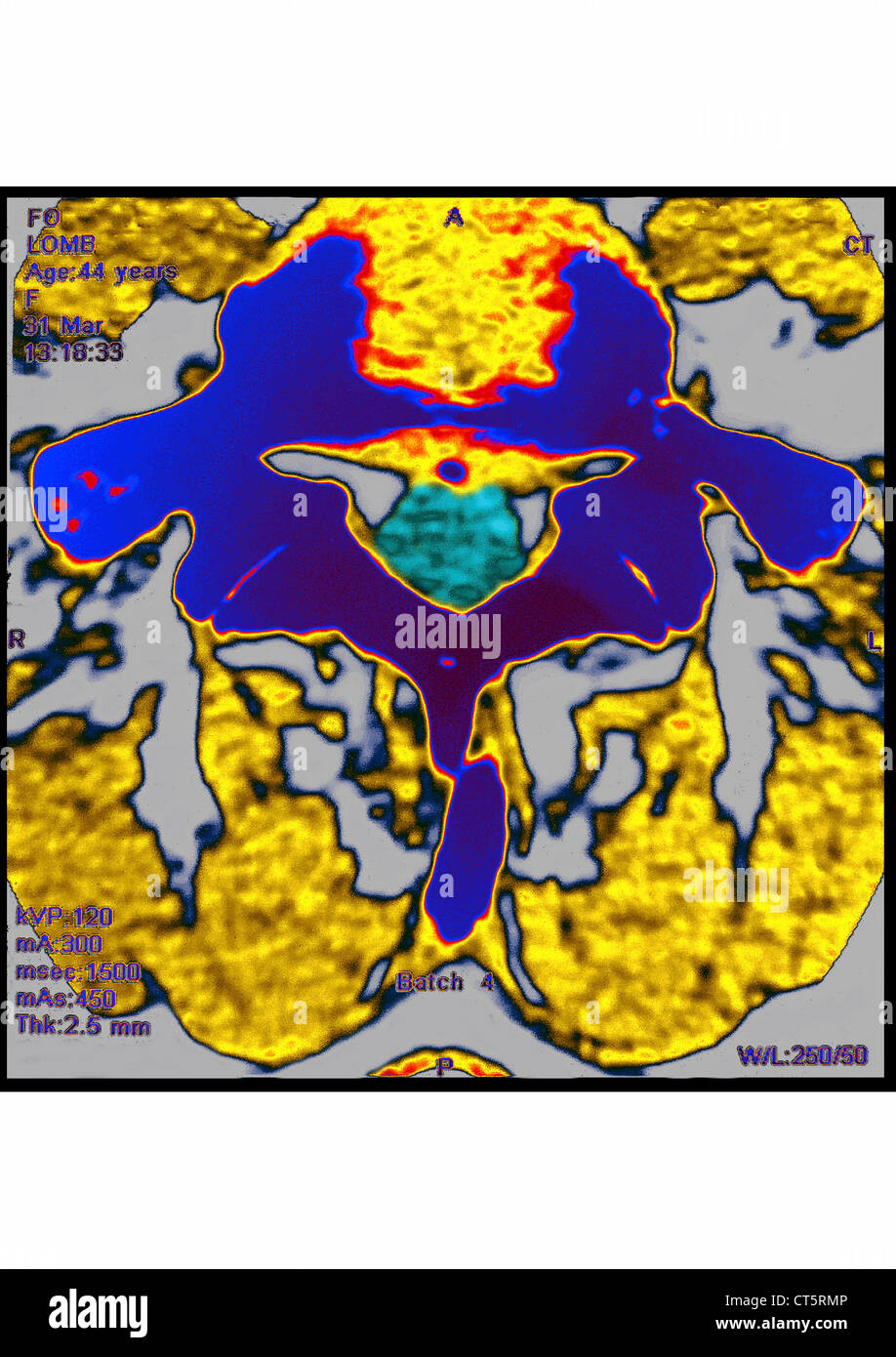 Herniated lumbar disc mri hires stock photography and images Alamy