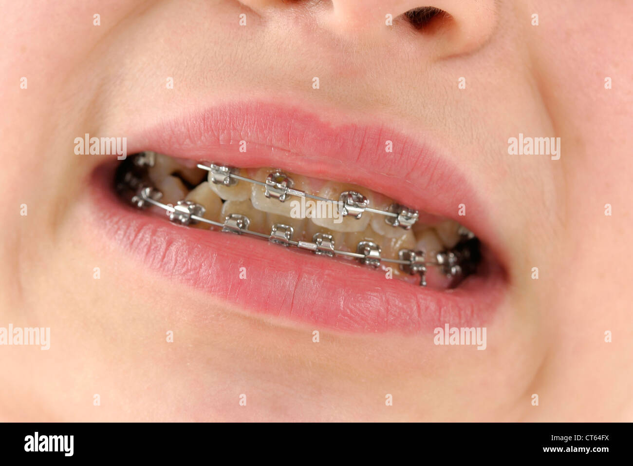 Close up dental brace hires stock photography and images Alamy