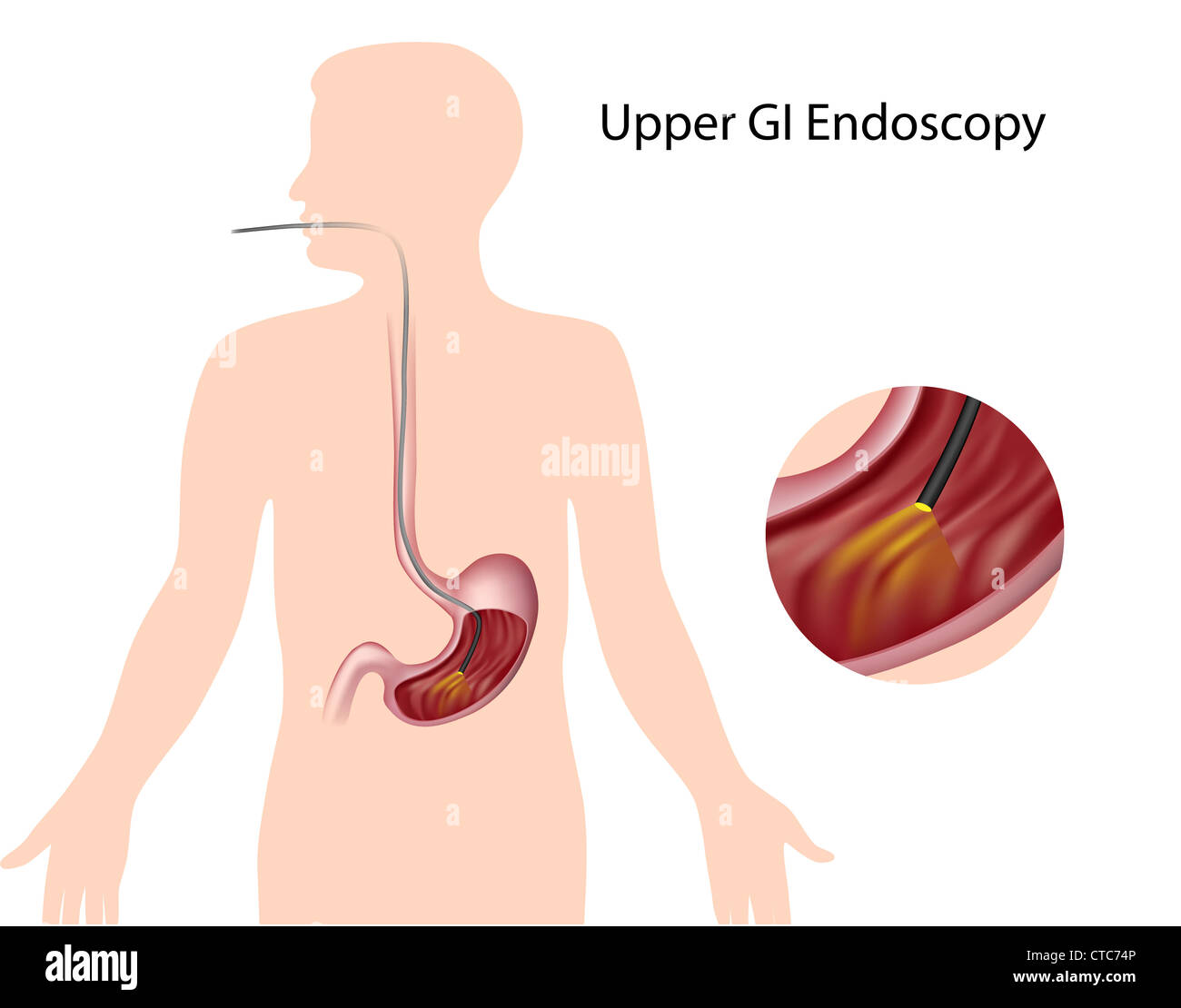 Endoscopy esophagus hires stock photography and images Alamy