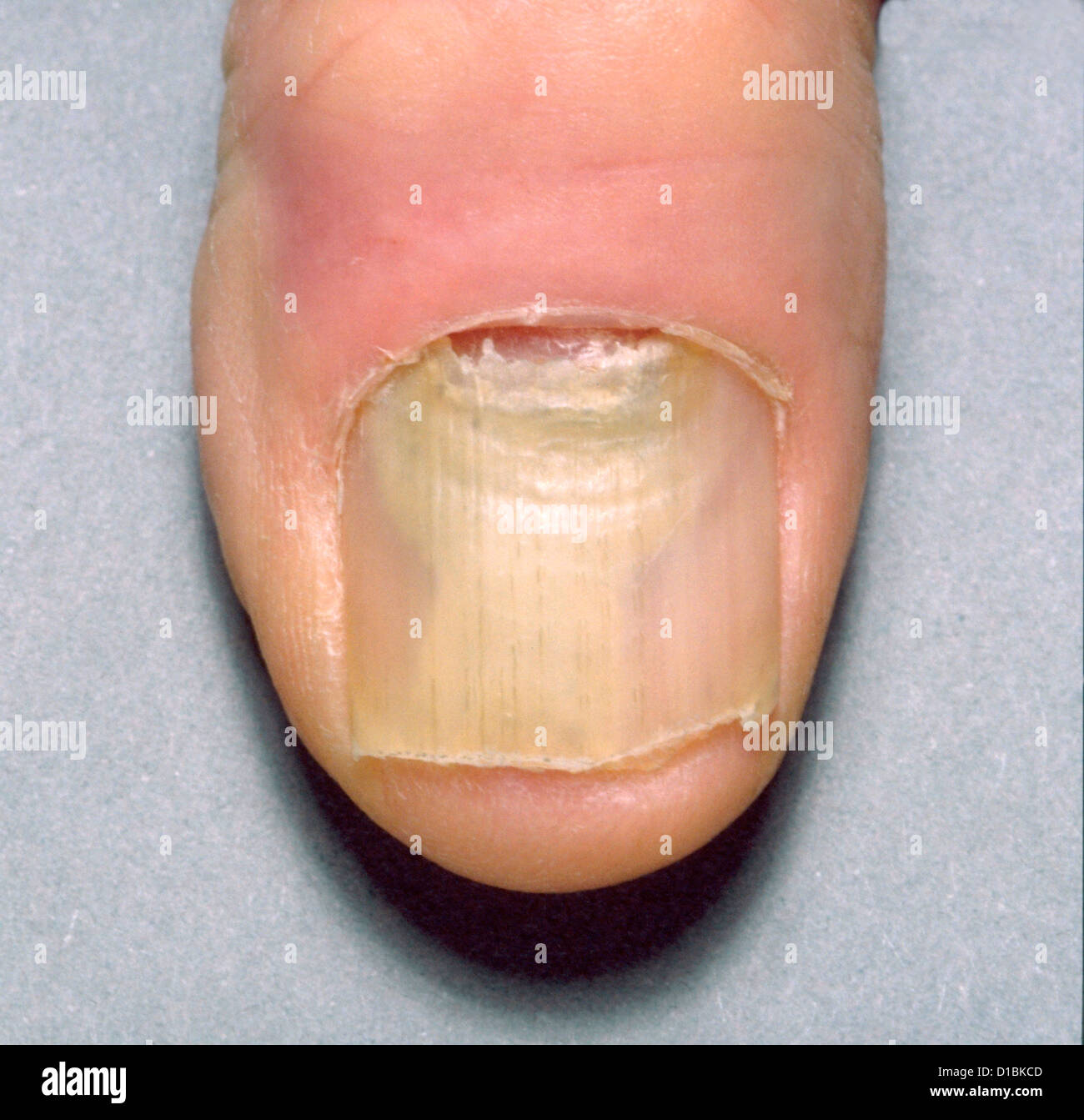 NAIL DYSTROPHY Stock Photo Alamy