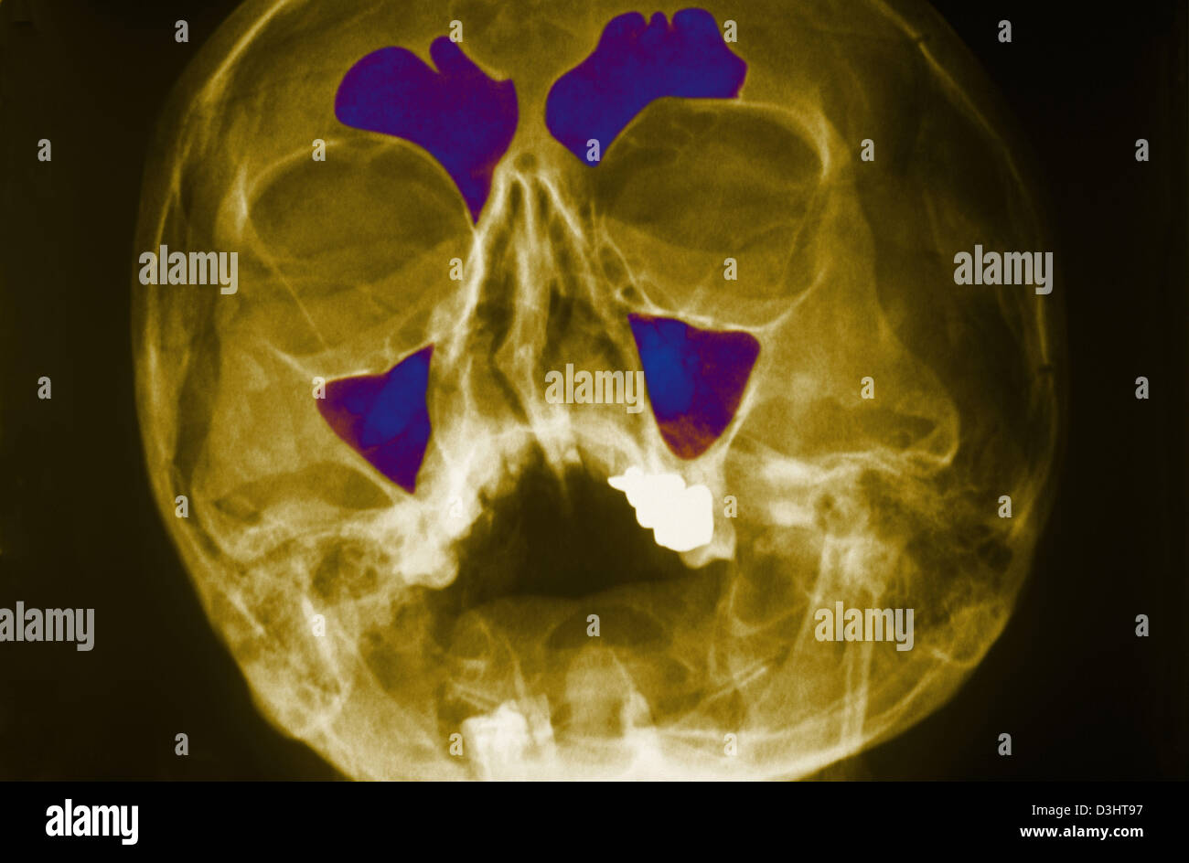 Sinus X Ray Series