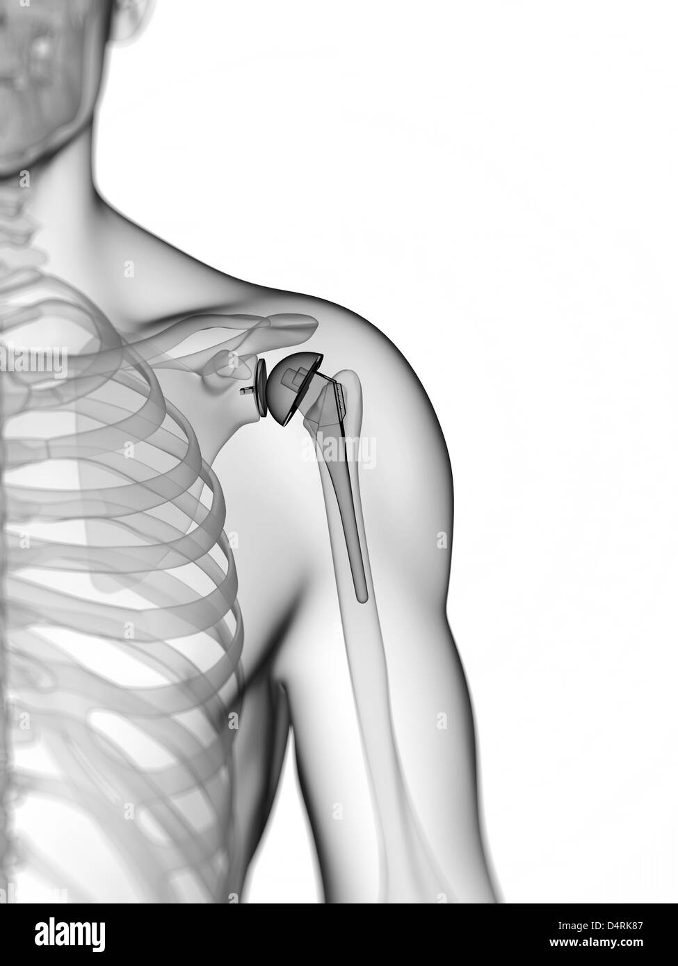 Human shoulder replacement Black and White Stock Photos & Images Alamy