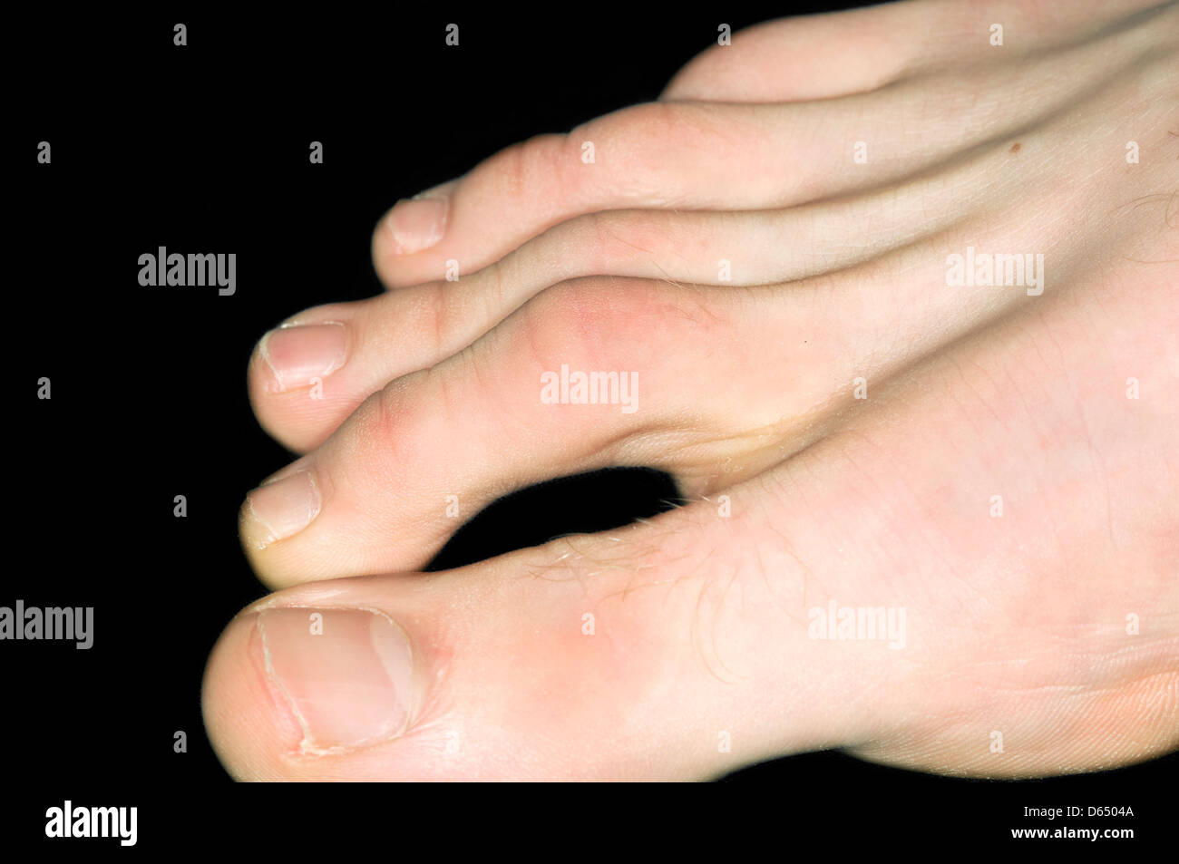 Hammer toes hires stock photography and images Alamy