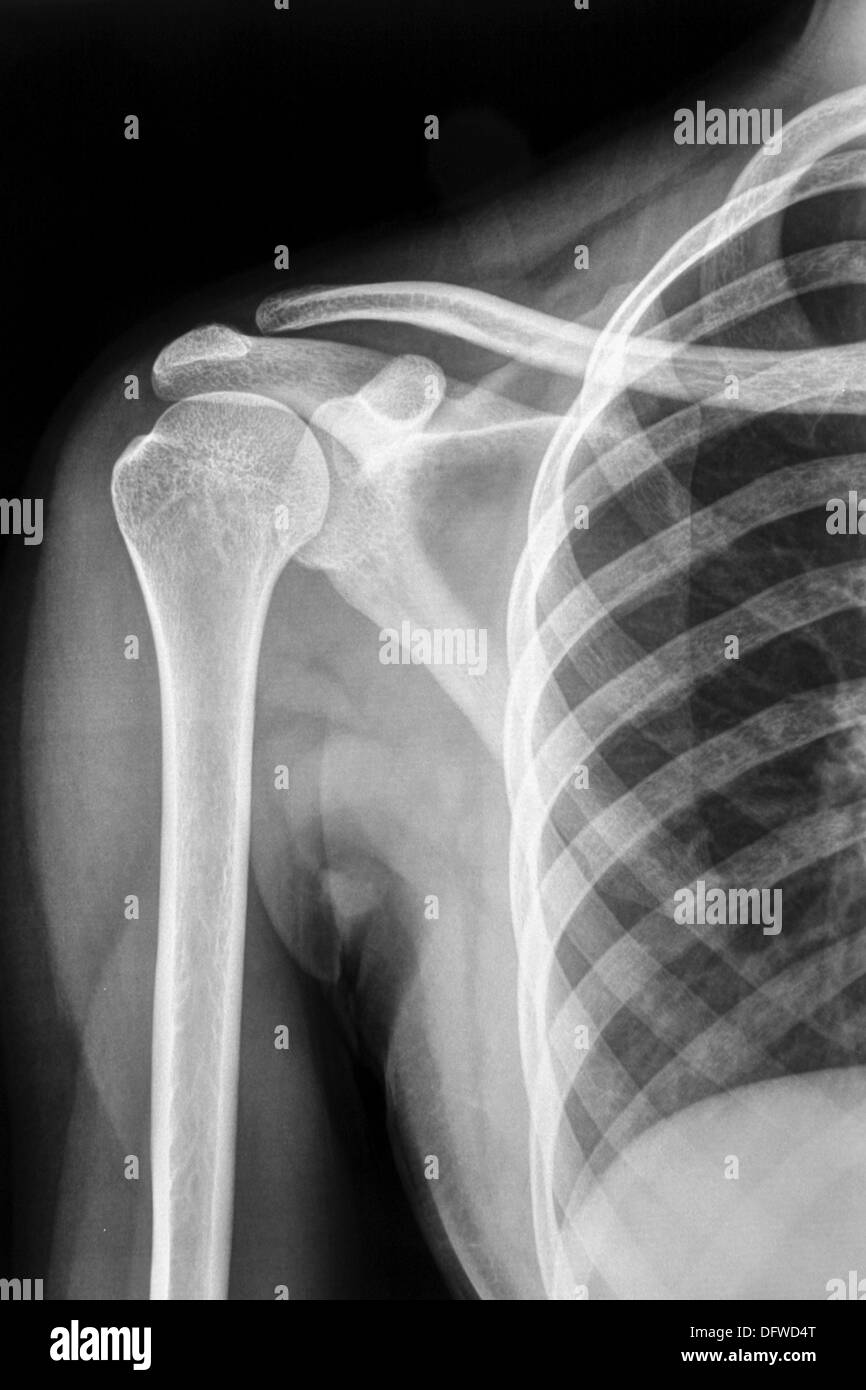 Collarbone X Ray High Resolution Stock Photography and Images Alamy
