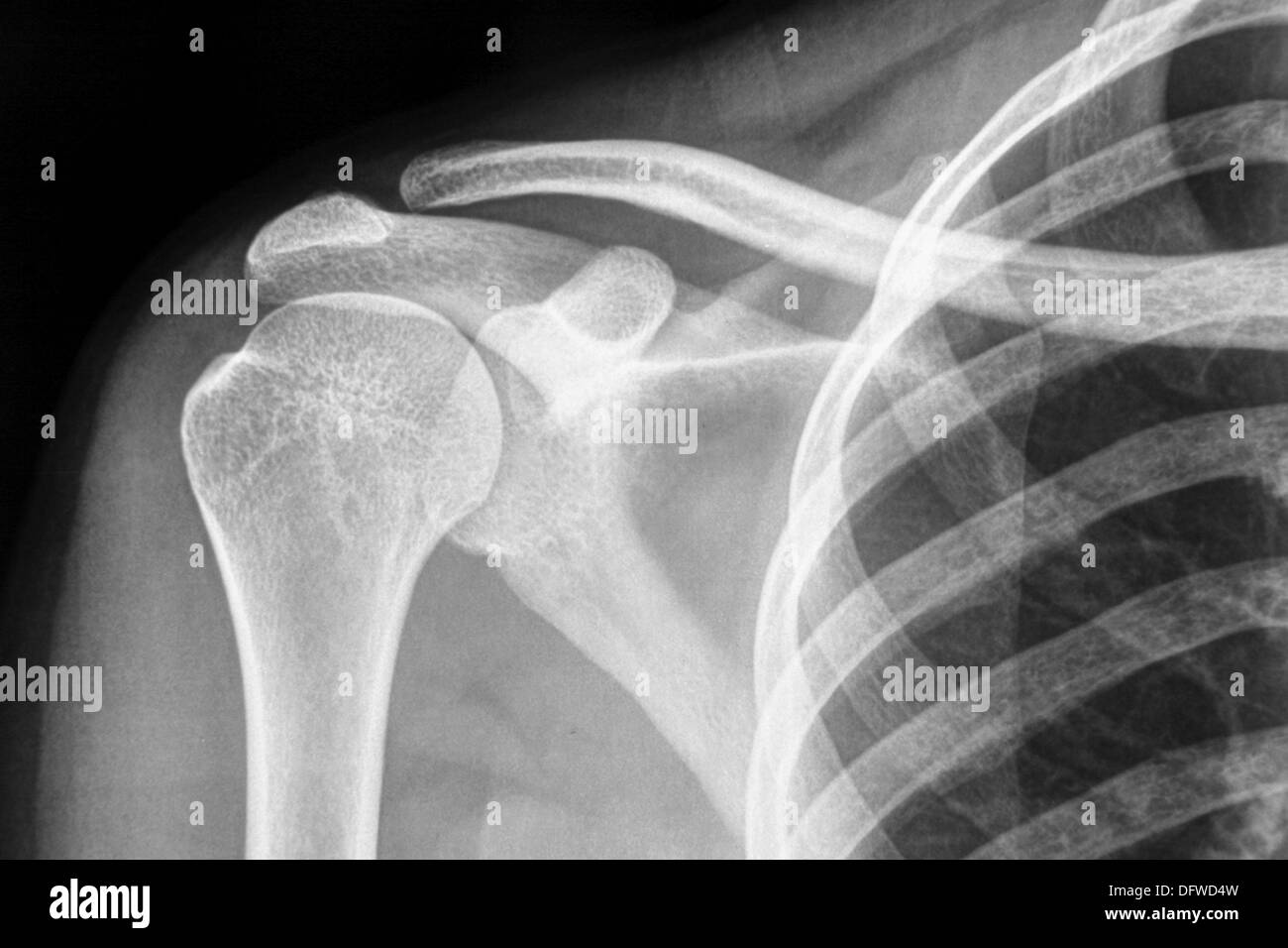 Collarbone x ray hires stock photography and images Alamy