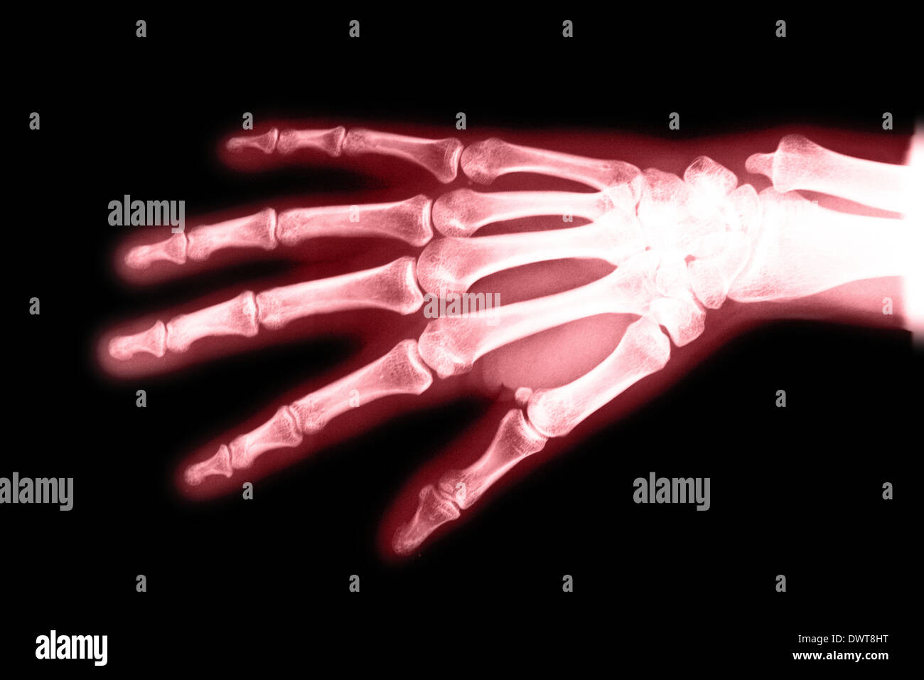 Hand x ray Stock Photo Alamy